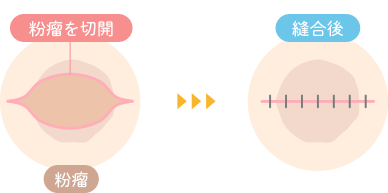 一般的な粉瘤の手術